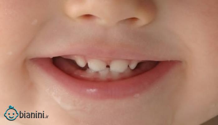 درمان آبسه دندان شیری کودکان و روش های پیشگیری از آن