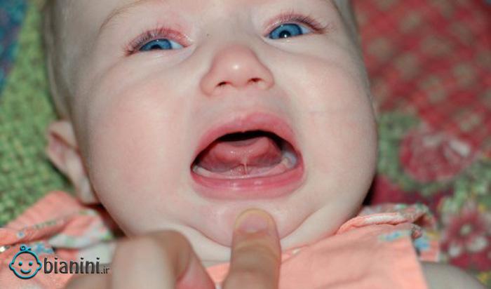 چسبندگی زبان به کف دهان نوزاد: دلایل، نشانه ها و راه های درمان