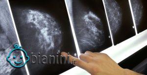 چند دلیل مهم برای انجام تست غربالگری سرطان سینه
